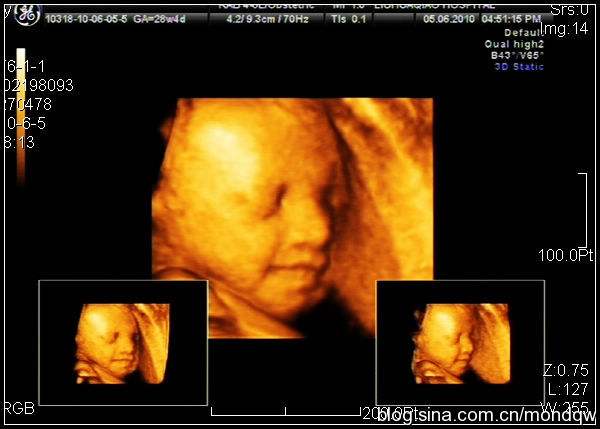 b超显示胎儿脑积水0.4,胎儿左侧脑室宽度9.2毫米是畸形吗