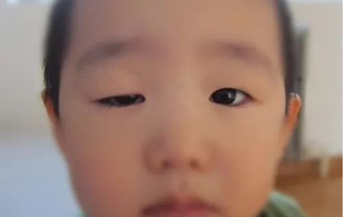 家长警惕：孩子一只眼大、一只眼小，可能是摊上了一种病