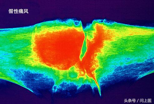 高中生膝盖疼痛的原因和解决方法,膝盖内侧靠下位置疼痛是什么原因