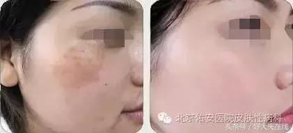 褐斑怎么治才能彻底消除,褐青色斑怎么治疗好