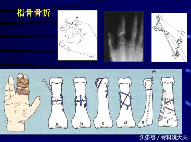 手肌腱损伤图片,手外伤神经肌腱损伤怎么定残