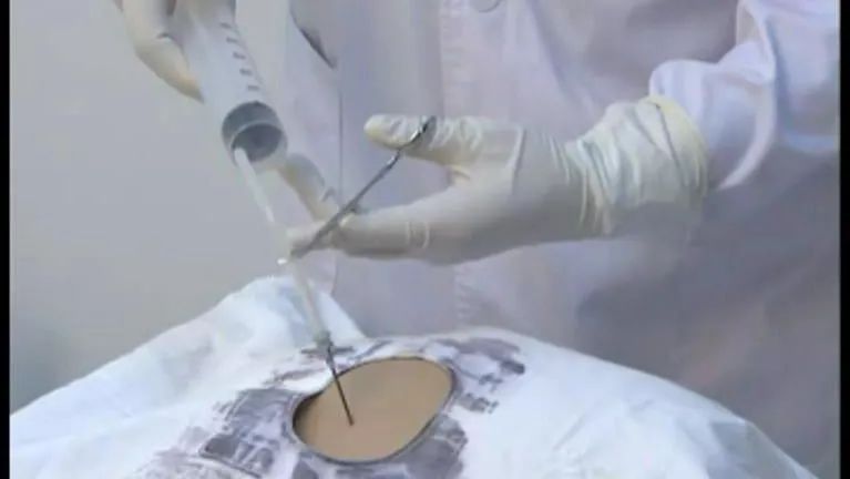 肝腹水的常见治疗误区有哪些,肝腹水治疗有哪几个误区