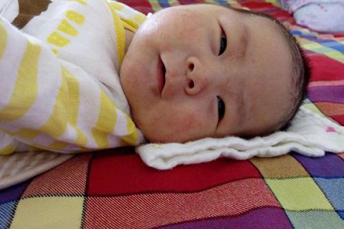 宝宝得了湿疹怎么解决,宝宝得湿疹严重怎么办