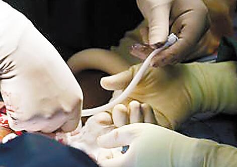 肾内科造瘘器械,肾内科颈内静脉球囊扩张术