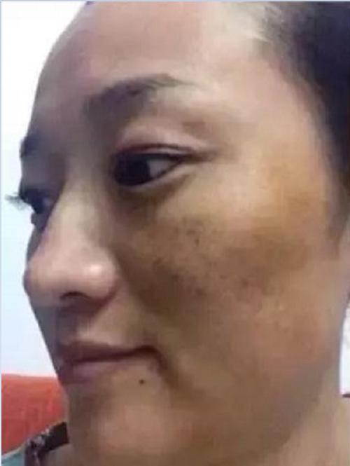 吃维生素c和维生素e能淡化痘印吗,维生素e软胶囊可以祛除痘印吗