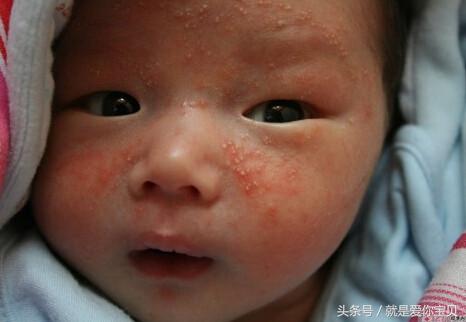 冬天儿童湿疹的最好解决方法,宝宝冬天湿疹高发怎么办