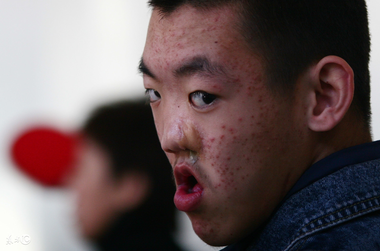 McCuneAlbright综合症,McCuneAlbright综合征