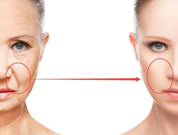 杨紫同款法令纹怎样去除,杨紫的法令纹怎么去掉的