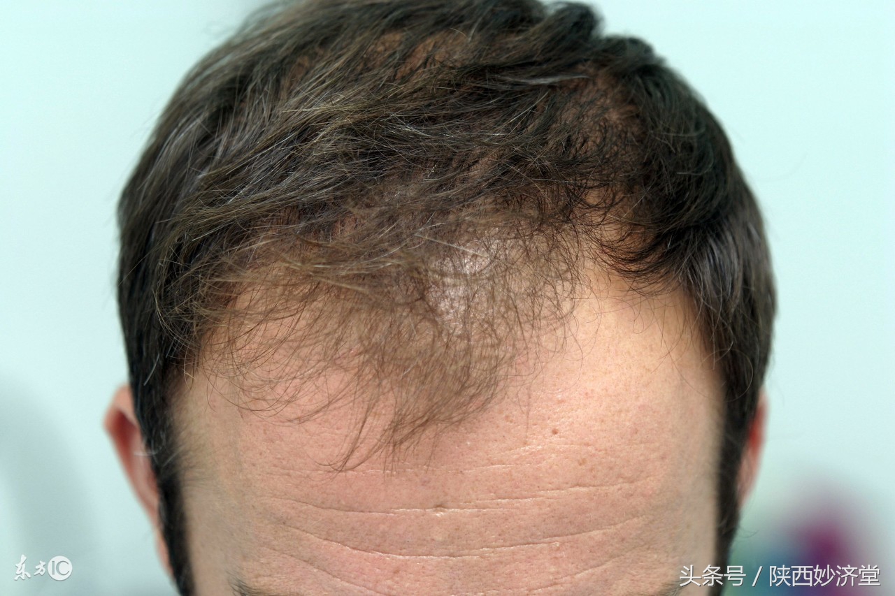 m发际线怎么修剪,有什么办法补救m型发际线