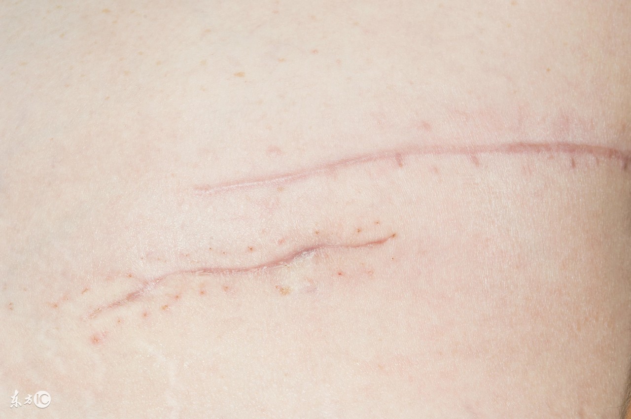 准妈妈们关于“侧切”和“撕裂”