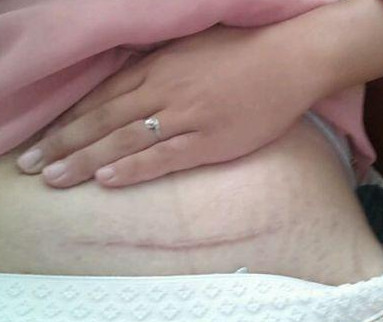 剖腹产怎么快速排气放屁,为什么剖腹产放屁以后才能吃饭