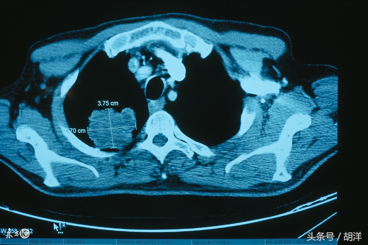 肺癌转移到骨头用唑来膦酸有用吗,肺癌转移骨头还咳血吃中药能好吗