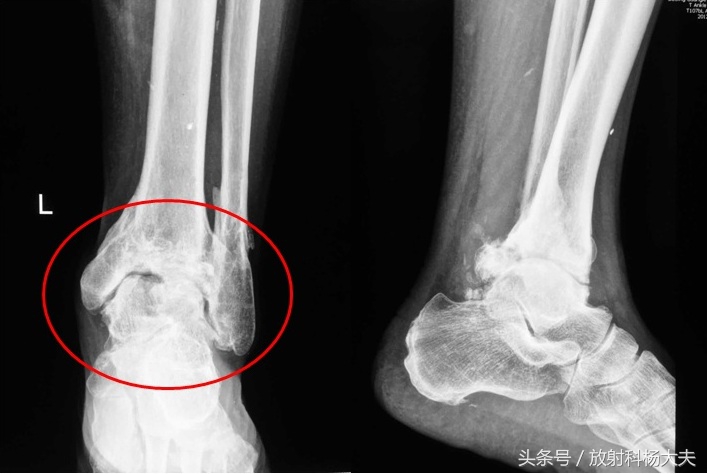 踝关节骨性关节炎变形严重,踝关节骨性关节炎发展得快吗