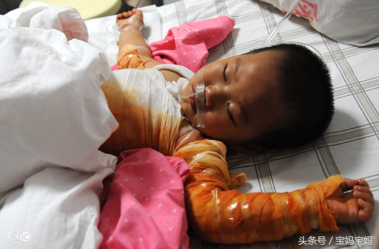 宝宝烫伤的正确处理方式,宝宝烫伤怎么处理好得快轻微