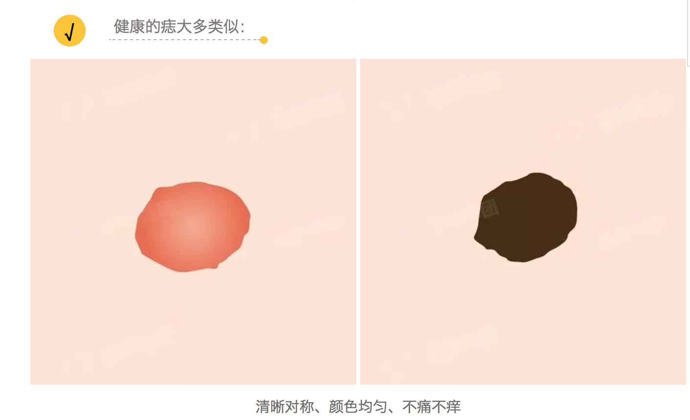 痣总是掉皮,痣发黑不规则