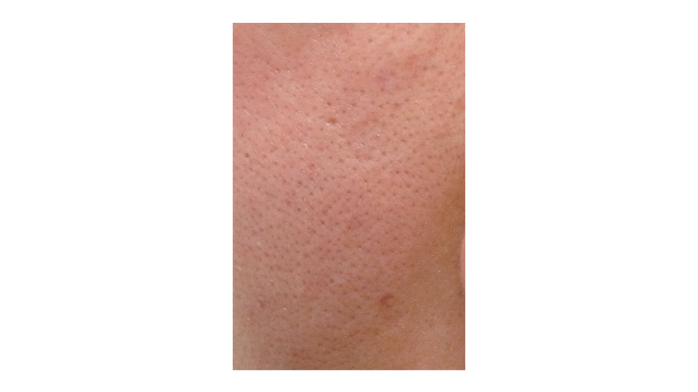 骞垮窞娣″寲鐥樺嵃鐥樺潙姣涘瓟绮楀ぇ,娣″寲鐥樺嵃鐥樺潙姣涘瓟绮楀ぇ鐢风敓