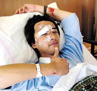 那些因为拍戏而受伤的演员,因拍戏而受伤的明星们