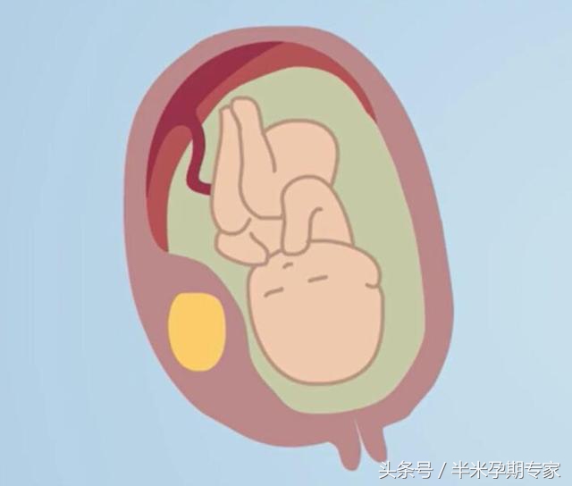 孕期查出子宫肌瘤怎么办,孕期发现子宫肌瘤怎么办