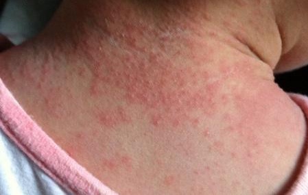 婴儿脸上疹子,婴儿疹子