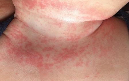 婴儿脸上疹子,婴儿疹子