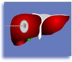 原发性肝癌早期射频消融能治好吗,原发性肝癌诊疗指南2024年版原文