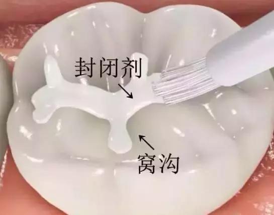 宝宝乳牙龋齿严重用拔牙不,孩子乳牙龋齿有必要补牙吗