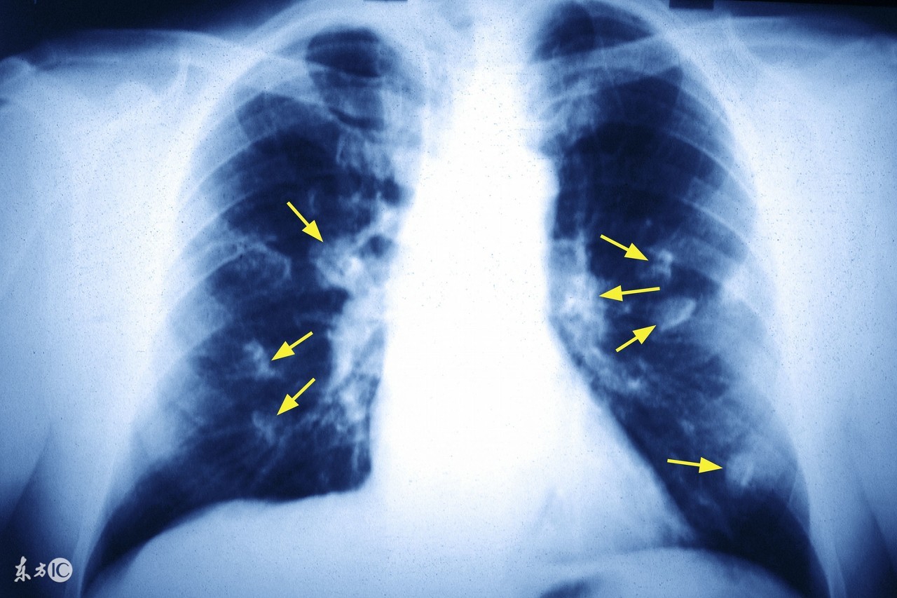 肺癌治疗不及时,肺癌微创手术后会出现哪些并发症