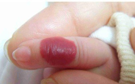 婴儿血管瘤常规治疗,皮肤血管瘤治疗方法