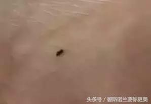 碧*诺斯**兰要你更美：用手抠掉痂皮，没色你怪谁？