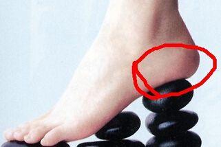 脚跟裂开用什么东西最有效,夏季治疗脚跟裂绝招