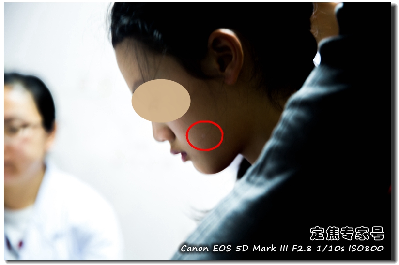 头皮一块一块的红斑,头皮癣治疗要多少钱