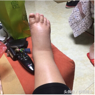 孕期水肿太厉害了怎么办,孕期水肿有什么缓解方法