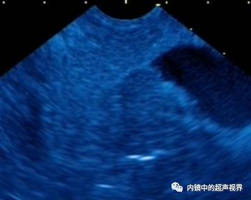 超声内镜美图攻略——动态范围与伪彩