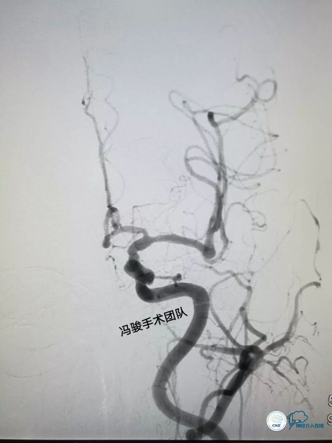 天新福—百家百言｜一例孤独椎动脉V4段并PICA重度狭窄支架手术及1年随访
