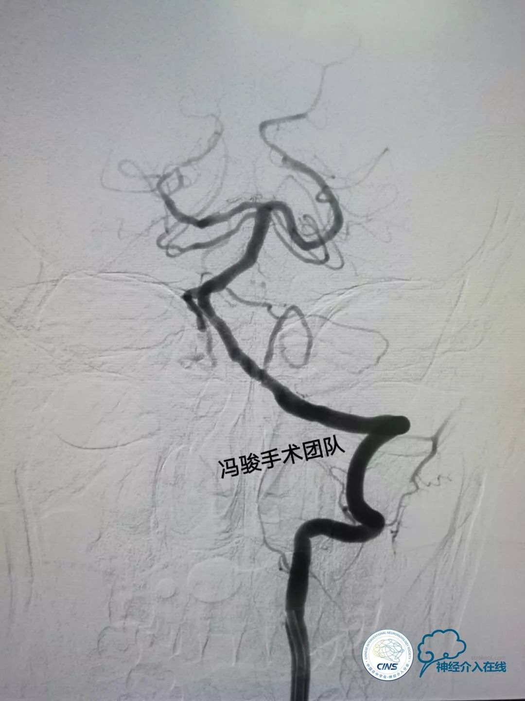 天新福—百家百言｜一例孤独椎动脉V4段并PICA重度狭窄支架手术及1年随访