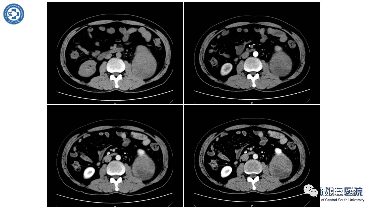「每日一例｜489例」男，左侧腰部撞伤后疼痛3月