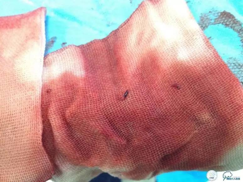 急性缺血性卒中静脉溶栓2018指南,急性缺血性卒中血管内再通标准