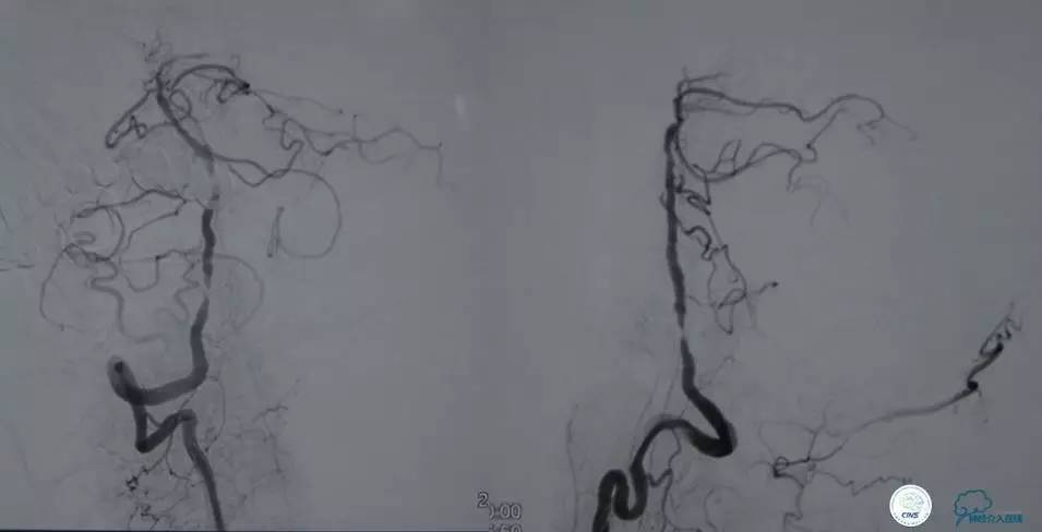 急性缺血性卒中静脉溶栓2018指南,急性缺血性卒中血管内再通标准