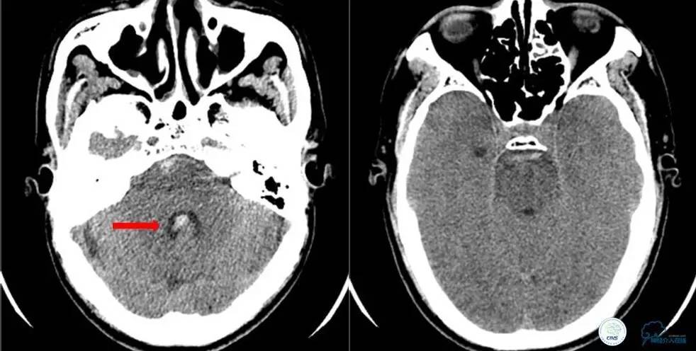 颈椎压迫椎动脉按摩正骨行吗,按摩斜角肌会导致椎动脉夹层吗