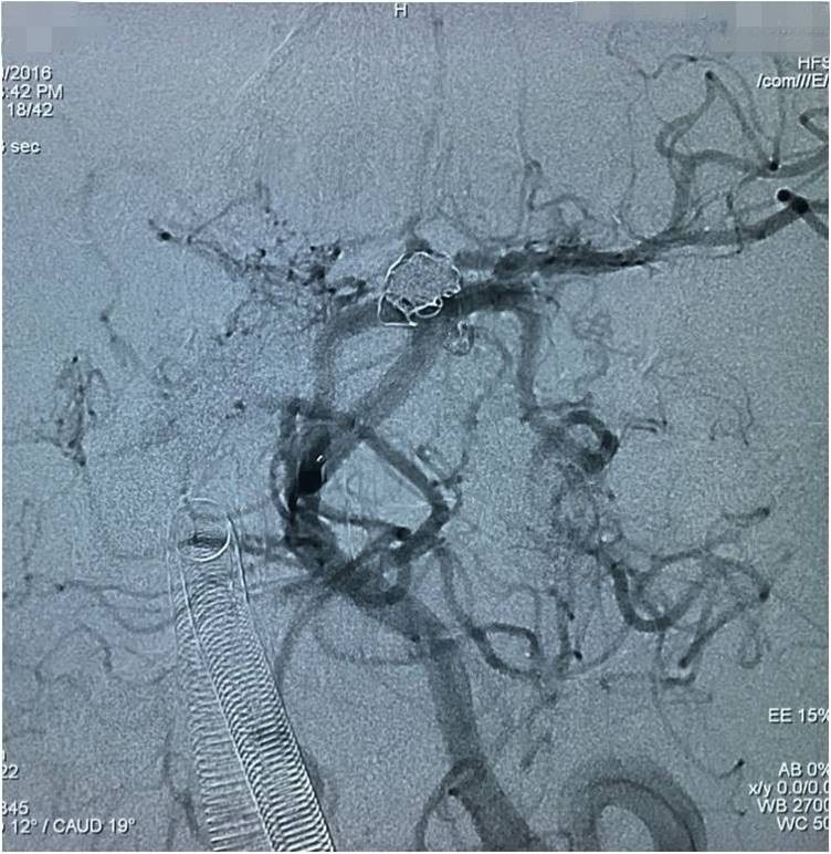 基底动脉顶端动脉瘤加左侧小脑上动脉瘤以Y型支架结合弹簧圈栓塞