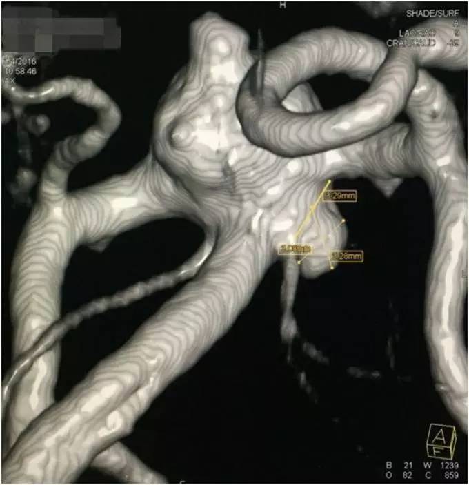 基底动脉顶端动脉瘤加左侧小脑上动脉瘤以Y型支架结合弹簧圈栓塞