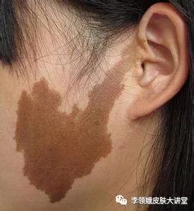 「杏林微科普」异斑异法早知道