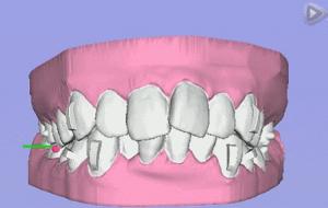 隐形矫正真的那么好吗？赵美牙带你破解隐形矫正五大谣言