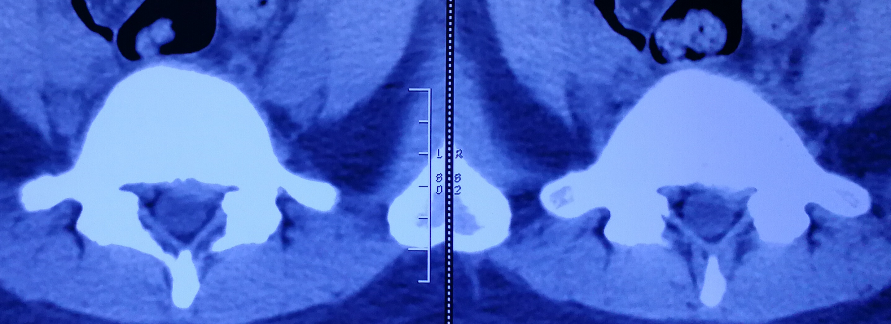 美女们的腰椎间盘突出这么多?