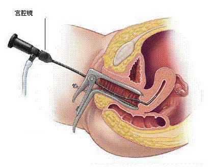 宫腔镜检查的亲身经历,检查宫腔镜