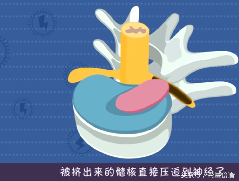 坐不久站不久用什么治疗,刚刚腰椎间盘突出怎么办