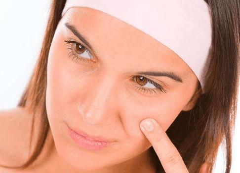 激素皮炎激素脸,糖皮质激素依赖性皮炎症状及治疗