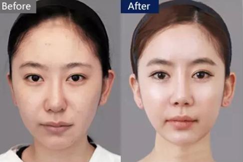 一次水光针=200片面膜？是真的！但为啥我还是不推荐你打水光针？