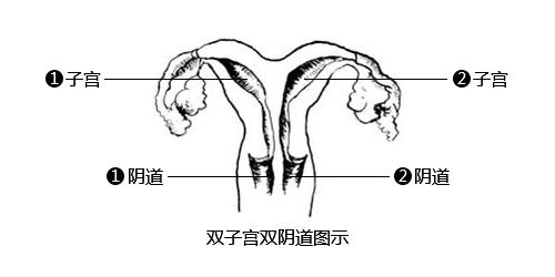 双子宫妇女怀孕的几率有多少,女性双子宫怀孕是不是很危险
