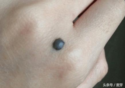 黑痣用针挑了会留疤吗,长黑痣用什么药去掉